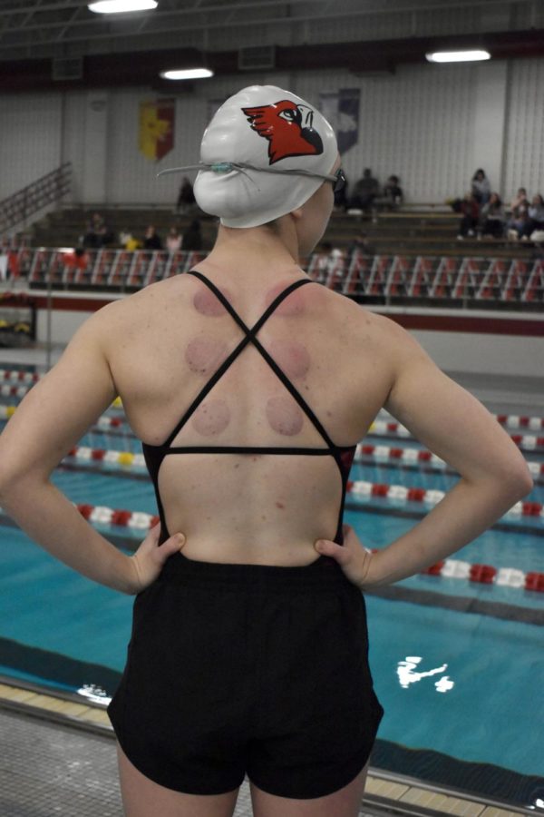 Senior+Noelle+Bryan+looks+across+the+pool+on+Jan.+24+at+the+SHS+natatorium.+The+circular+marks+on+her+back+are+from+cupping%2C+which+is+one+of+the+methods+she+uses+to+keep+her+injury+under+control.